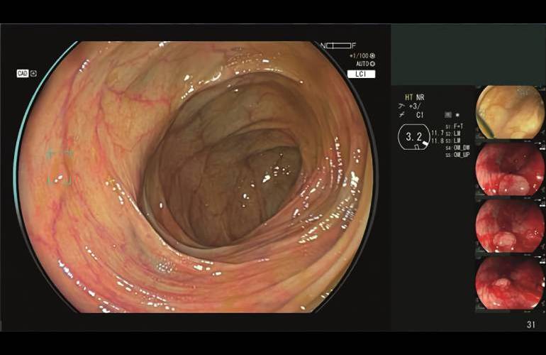 Fujifilm Cad Eye AI powered endoscopy