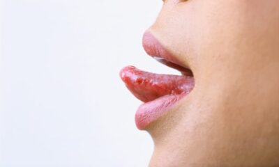 Tongue Ulcers 