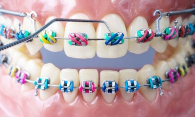Orthodontic Retainers: Their Importance and Maintenance