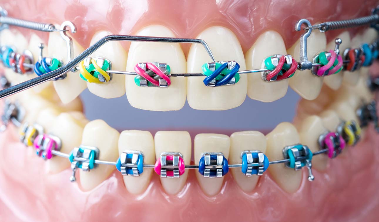 Orthodontic Retainers: Their Importance and Maintenance