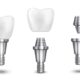 The Price of Smiles: Dental Implants in Moody, AL