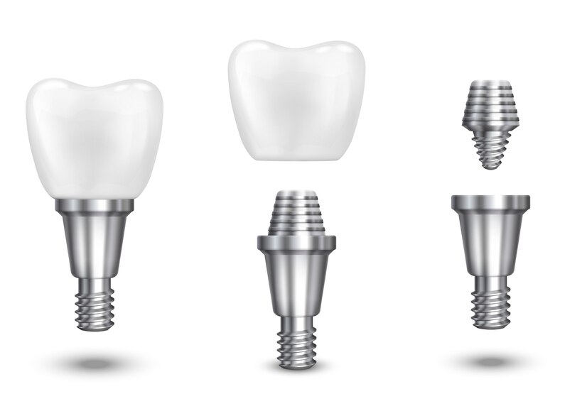 The Price of Smiles: Dental Implants in Moody, AL