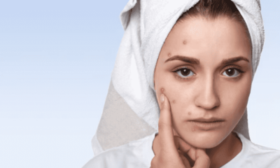 Top Tips on How to Cope with and Reduce Adult Acne