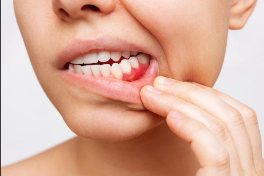 Understanding Bleeding Gums: Causes, Prevention, and Treatment