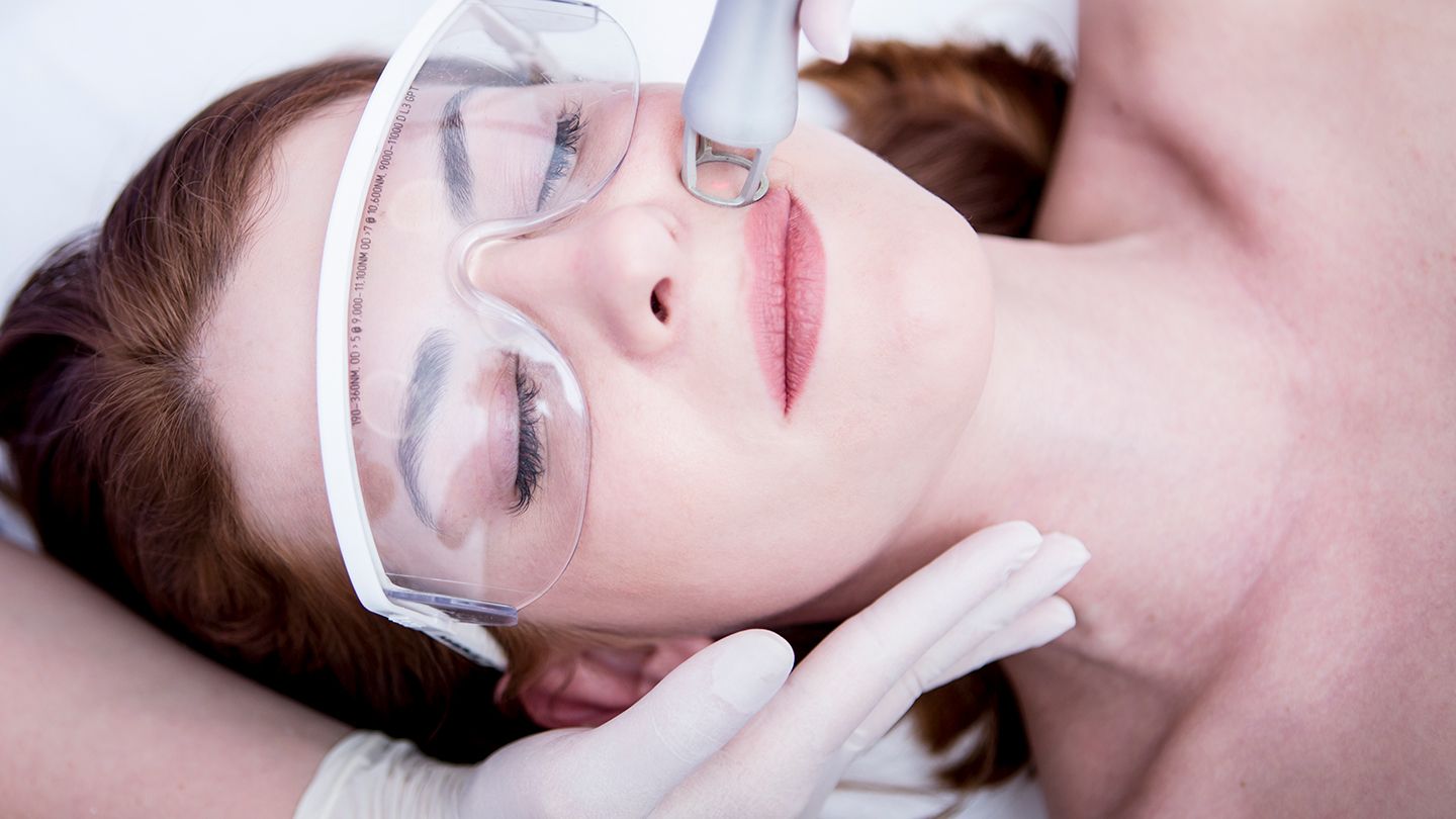 What is carbon dioxide laser resurfacing?